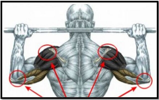 Il carico sui muscoli della spalla e del gomito è una delle cause dell'artrosi dell'articolazione della spalla