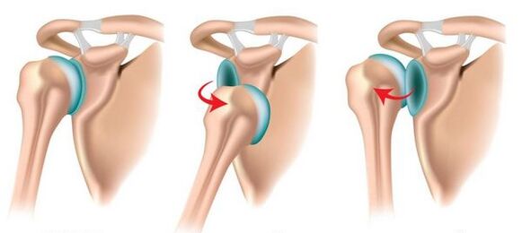 Lussazione anteriore e posteriore dell'articolazione della spalla, provocando lo sviluppo dell'artrosi