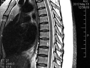 Risonanza magnetica della colonna vertebrale toracica
