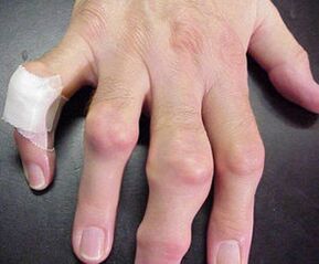 le dita con deformità articolari causano dolore