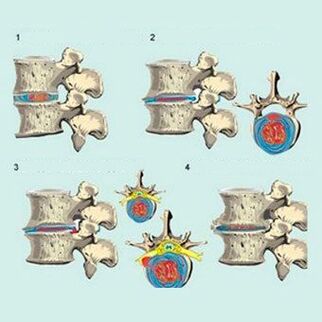 fasi di sviluppo dell'osteocondrosi cervicale