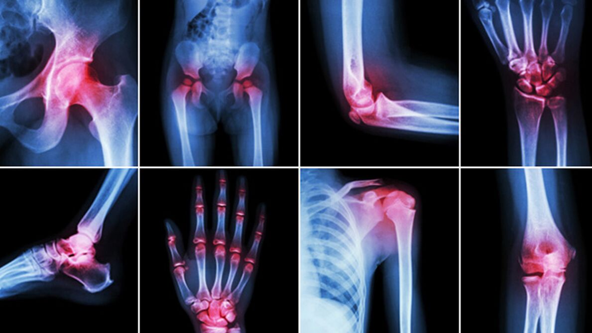 Radiografie per dolori articolari
