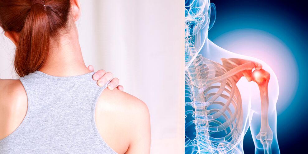 Lo sviluppo dell'artrosi della spalla porta gradualmente a un dolore costante