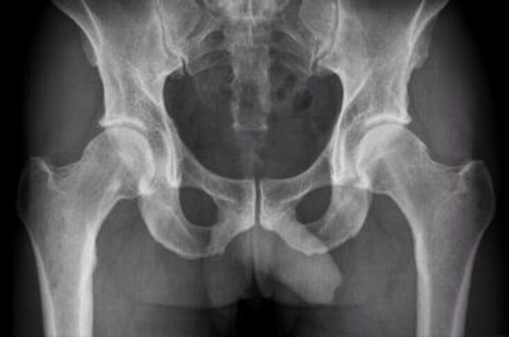 radiografia dell'articolazione dell'anca per il dolore