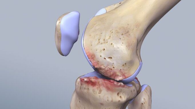 La struttura dell'articolazione del ginocchio colpita dalla patologia