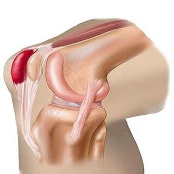 Una delle cause del dolore all'articolazione del ginocchio è la borsite. 