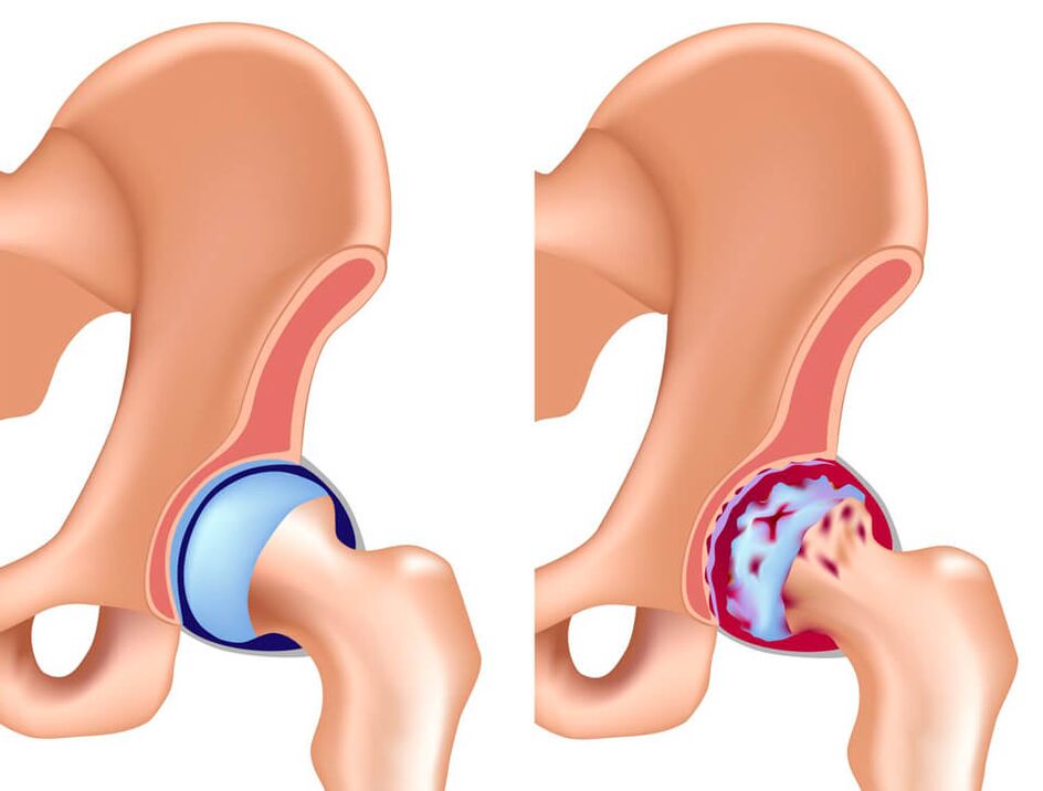 La causa più comune di dolore all'articolazione dell'anca è la coxartrosi. 