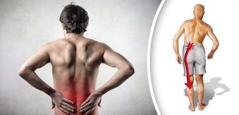 La sindrome del dolore con osteocondosi lombare si irradia alle gambe
