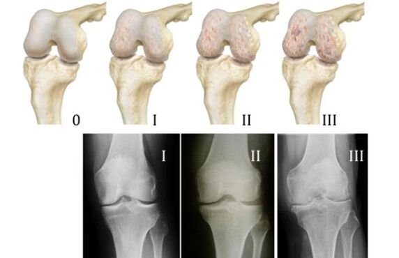 Metodi per diagnosticare l'artrosi del ginocchio