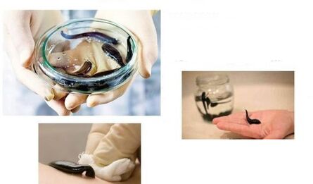 irudoterapia per l'artrosi